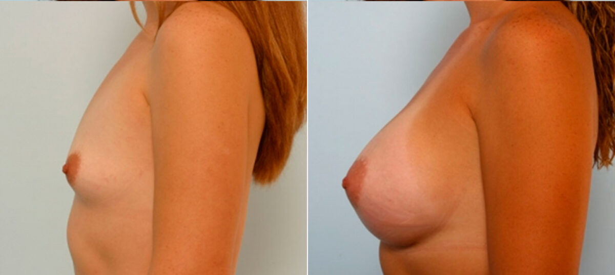 Breast Augmentation before and after photos in Houston, TX, Patient 25097