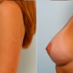 Breast Augmentation before and after photos in Houston, TX, Patient 25097