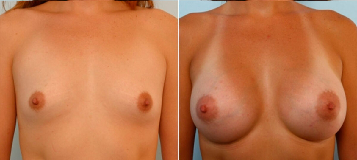 Breast Augmentation before and after photos in Houston, TX, Patient 25097