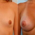 Breast Augmentation before and after photos in Houston, TX, Patient 25097