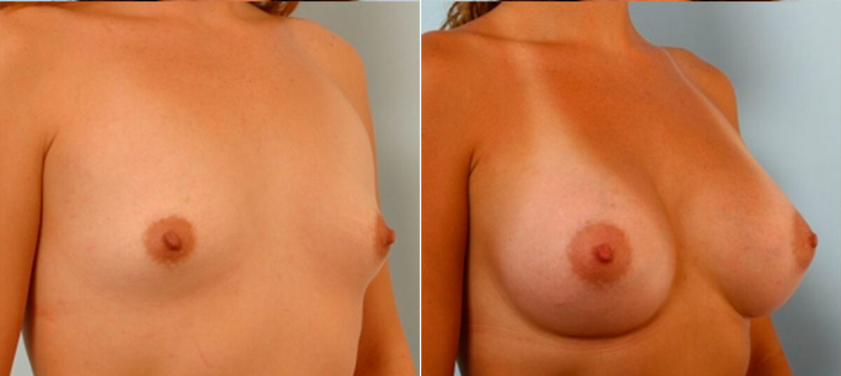 Breast Augmentation before and after photos in Houston, TX, Patient 25097