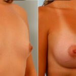 Breast Augmentation before and after photos in Houston, TX, Patient 25097