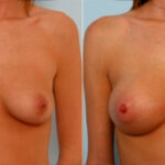 Breast Augmentation before and after photos in Houston, TX, Patient 25108