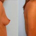 Breast Augmentation before and after photos in Houston, TX, Patient 25108
