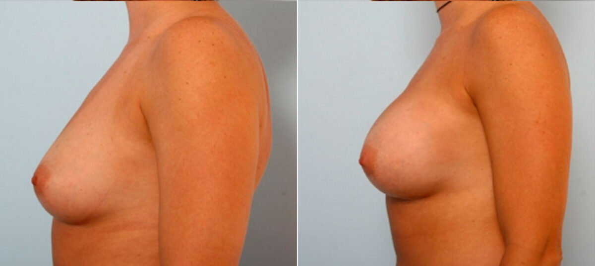 Breast Augmentation before and after photos in Houston, TX, Patient 25119