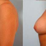 Breast Augmentation before and after photos in Houston, TX, Patient 25119