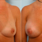 Breast Augmentation before and after photos in Houston, TX, Patient 25119