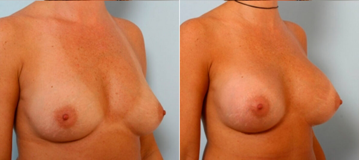 Breast Augmentation before and after photos in Houston, TX, Patient 25119