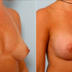 Breast Augmentation before and after photos in Houston, TX, Patient 25119