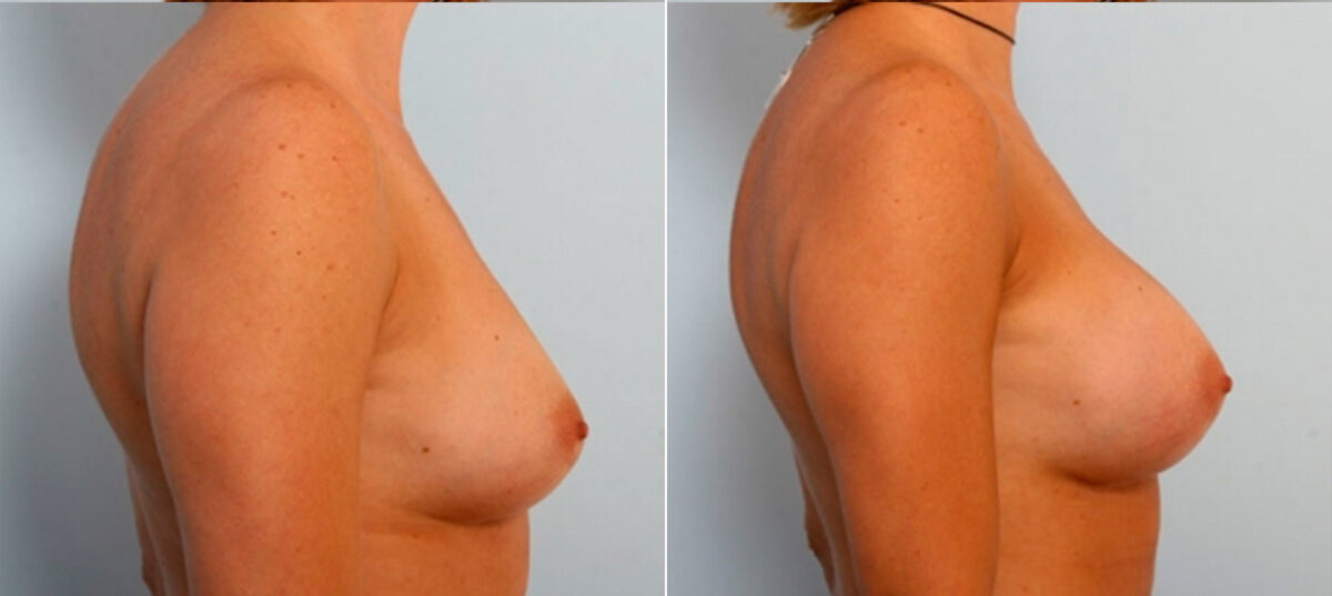 Breast Augmentation before and after photos in Houston, TX, Patient 25119