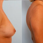 Breast Augmentation before and after photos in Houston, TX, Patient 25119