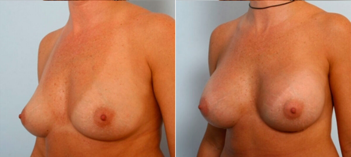 Breast Augmentation before and after photos in Houston, TX, Patient 25119