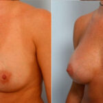 Breast Augmentation before and after photos in Houston, TX, Patient 25119