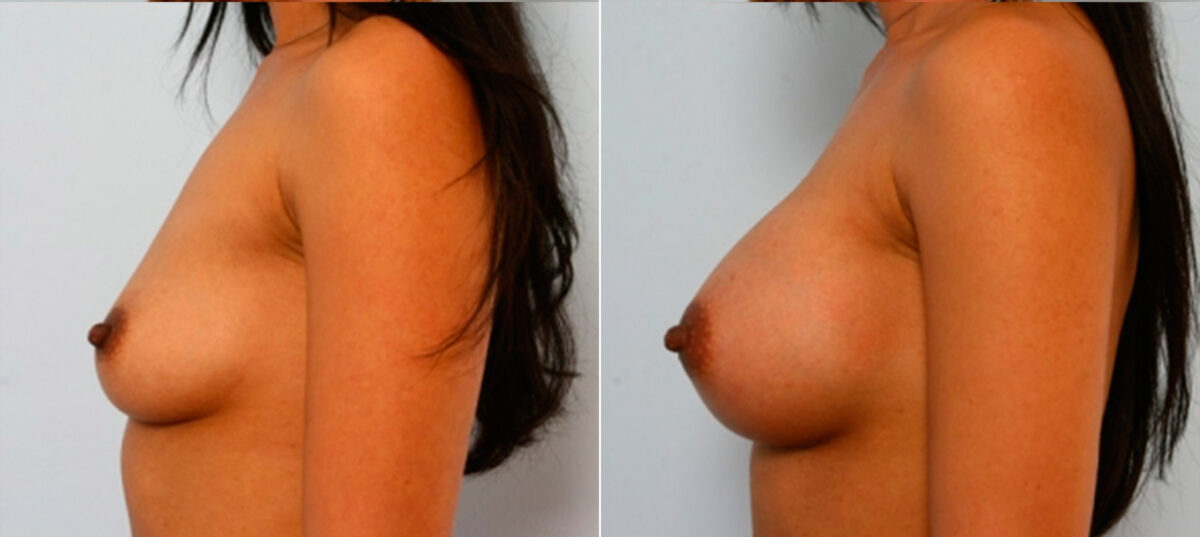 Breast Augmentation before and after photos in Houston, TX, Patient 25130