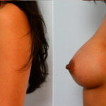 Breast Augmentation before and after photos in Houston, TX, Patient 25130