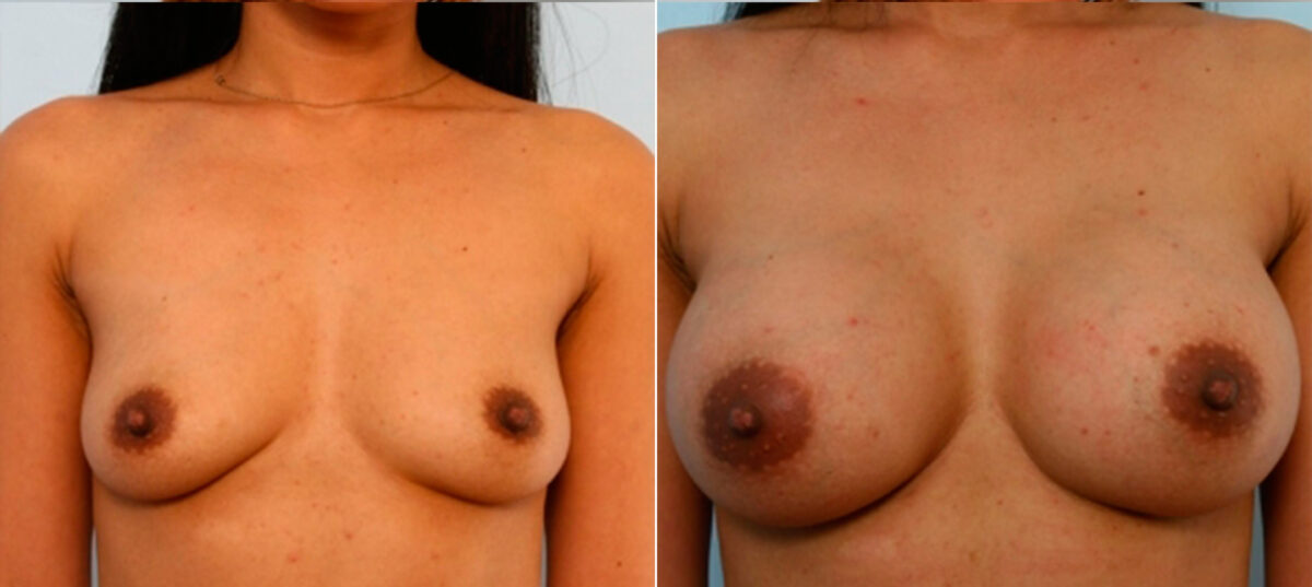 Breast Augmentation before and after photos in Houston, TX, Patient 25130