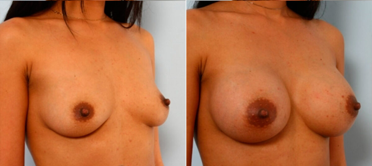 Breast Augmentation before and after photos in Houston, TX, Patient 25130