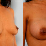 Breast Augmentation before and after photos in Houston, TX, Patient 25130