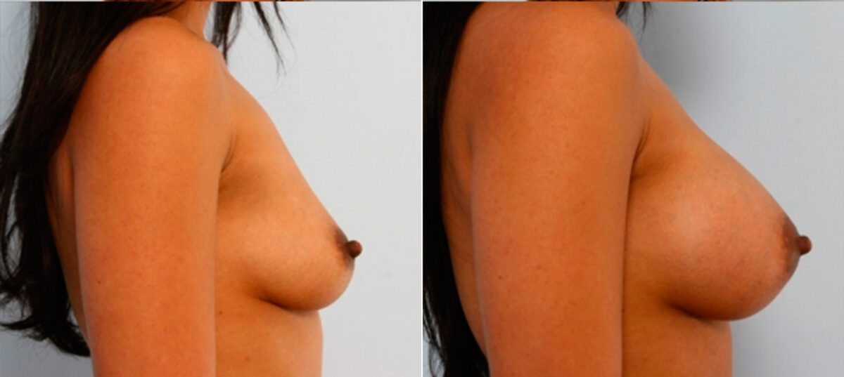 Breast Augmentation before and after photos in Houston, TX, Patient 25130