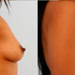 Breast Augmentation before and after photos in Houston, TX, Patient 25130