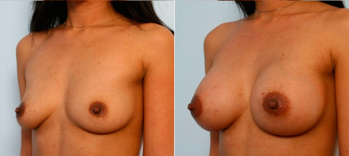 Breast Augmentation before and after photos in Houston, TX, Patient 25130