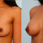 Breast Augmentation before and after photos in Houston, TX, Patient 25130