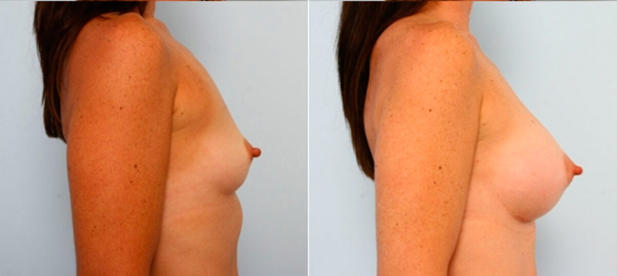 Breast Augmentation before and after photos in Houston, TX, Patient 25141