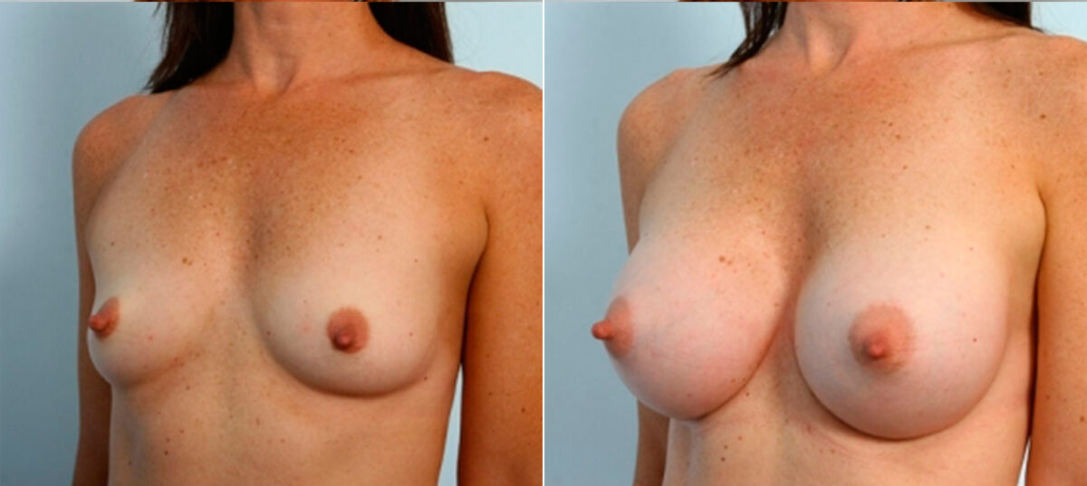 Breast Augmentation before and after photos in Houston, TX, Patient 25141