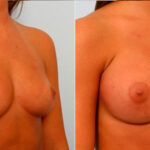 Breast Augmentation before and after photos in Houston, TX, Patient 25152