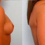 Breast Augmentation before and after photos in Houston, TX, Patient 25152