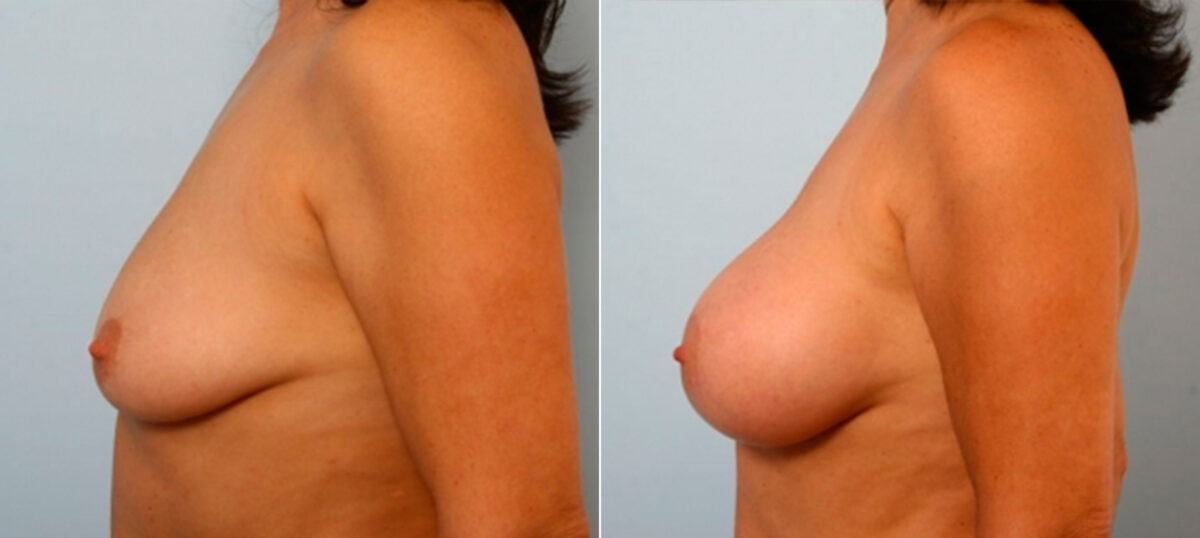 Breast Augmentation before and after photos in Houston, TX, Patient 25163