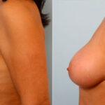 Breast Augmentation before and after photos in Houston, TX, Patient 25163