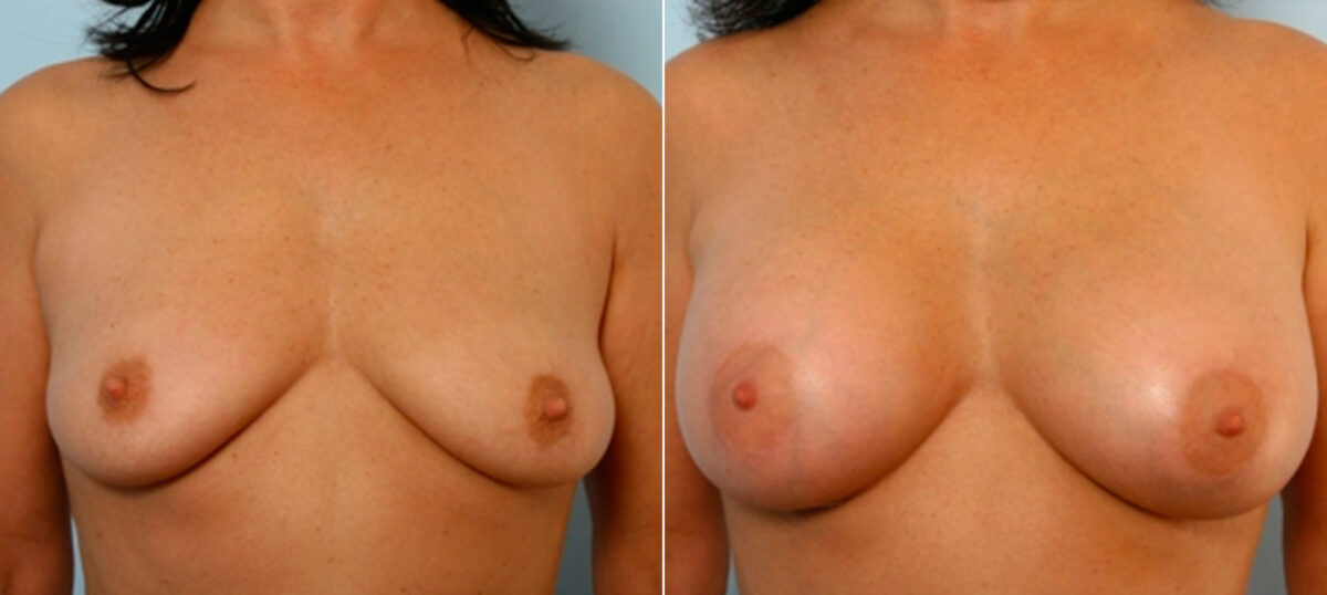 Breast Augmentation before and after photos in Houston, TX, Patient 25163