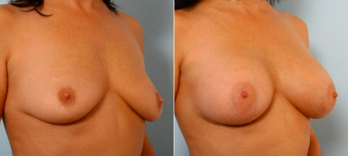 Breast Augmentation before and after photos in Houston, TX, Patient 25163