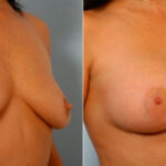Breast Augmentation before and after photos in Houston, TX, Patient 25163