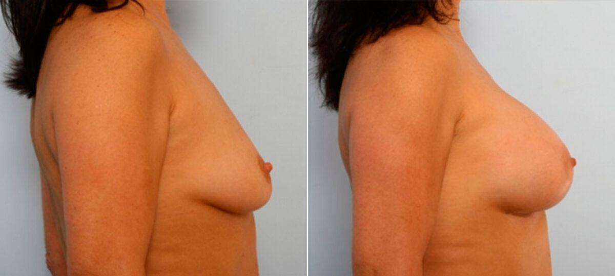 Breast Augmentation before and after photos in Houston, TX, Patient 25163