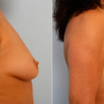 Breast Augmentation before and after photos in Houston, TX, Patient 25163