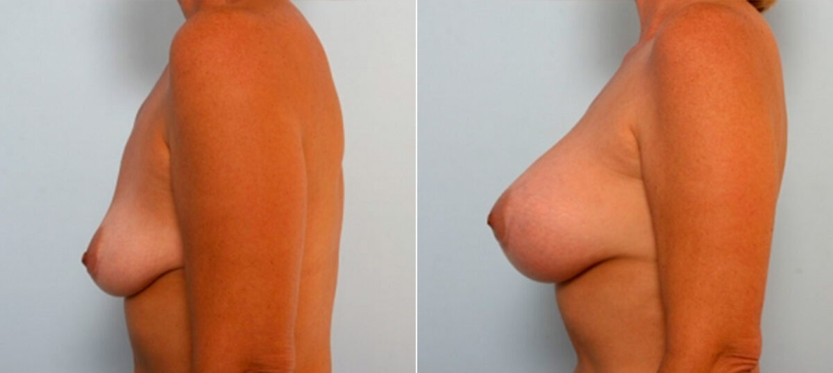 Breast Augmentation before and after photos in Houston, TX, Patient 25174