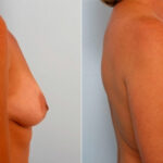 Breast Augmentation before and after photos in Houston, TX, Patient 25174