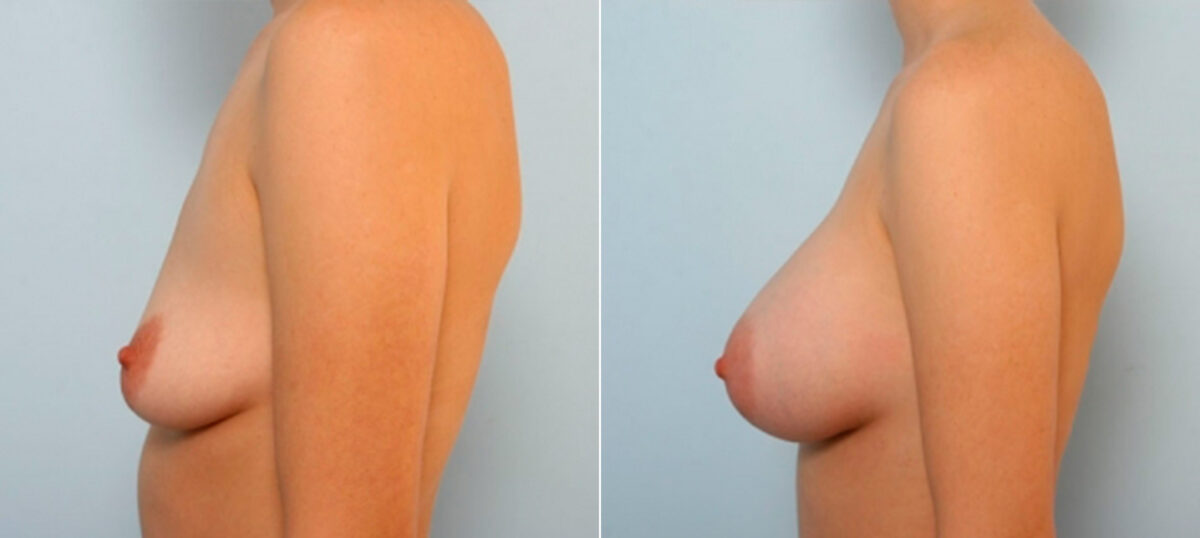 Breast Augmentation before and after photos in Houston, TX, Patient 25185