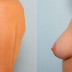 Breast Augmentation before and after photos in Houston, TX, Patient 25185