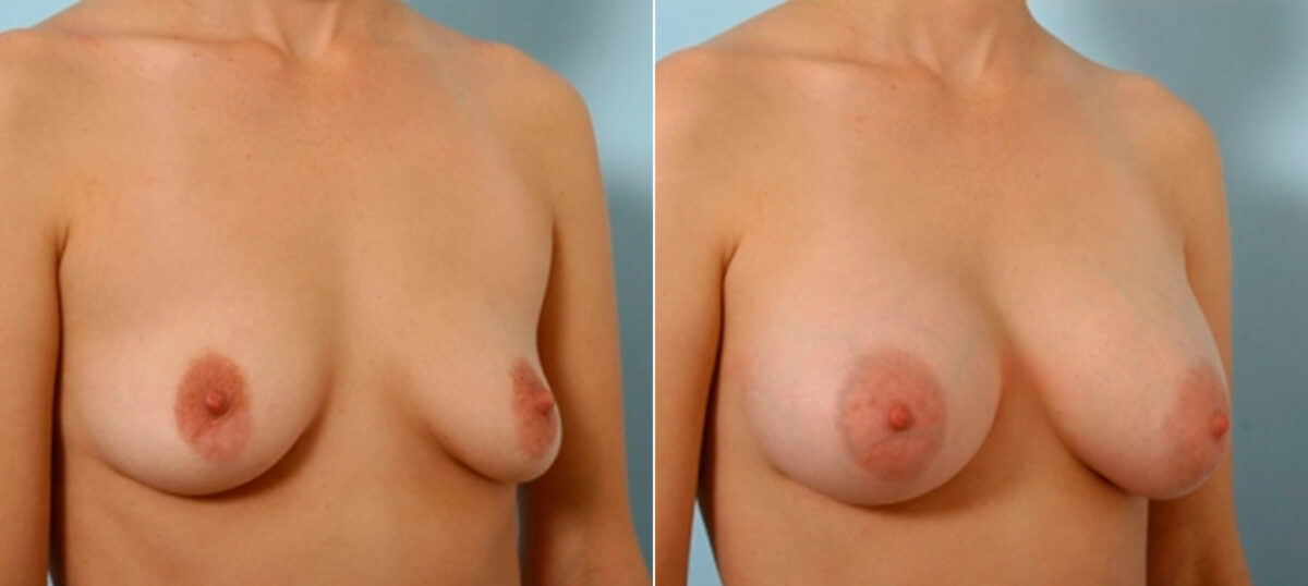 Breast Augmentation before and after photos in Houston, TX, Patient 25185