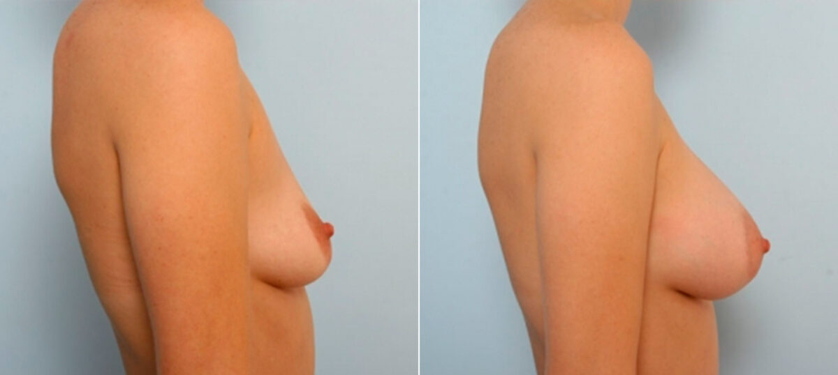 Breast Augmentation before and after photos in Houston, TX, Patient 25185