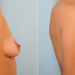 Breast Augmentation before and after photos in Houston, TX, Patient 25185