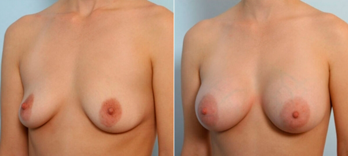 Breast Augmentation before and after photos in Houston, TX, Patient 25185
