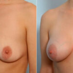 Breast Augmentation before and after photos in Houston, TX, Patient 25185