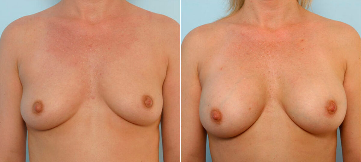 Breast Augmentation before and after photos in Houston, TX, Patient 25196