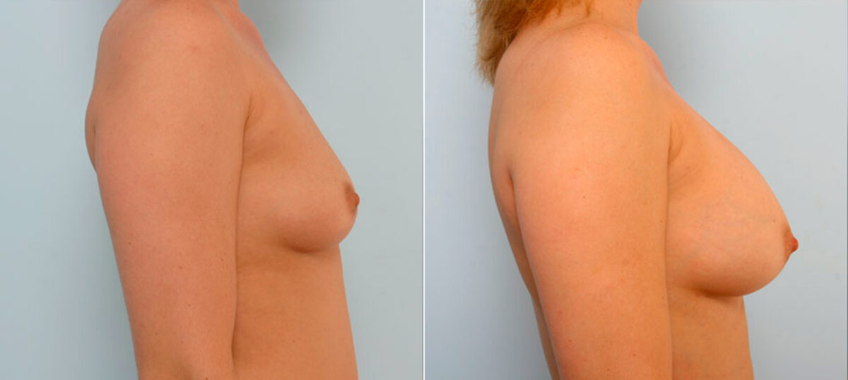 Breast Augmentation before and after photos in Houston, TX, Patient 25196