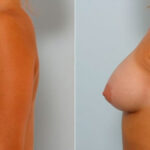 Breast Augmentation before and after photos in Houston, TX, Patient 25198