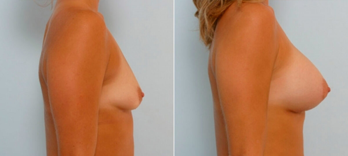 Breast Augmentation before and after photos in Houston, TX, Patient 25198
